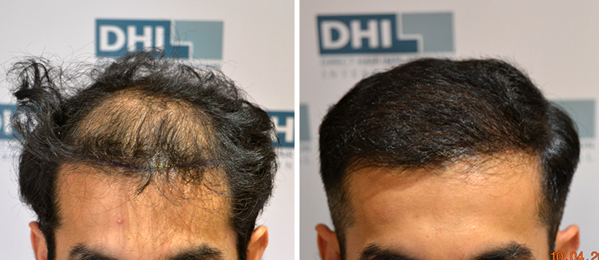 DHI before & after hair transplant results